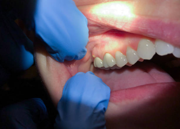 Best Emergency Treatment for Toothache in Mount Gilead, OH